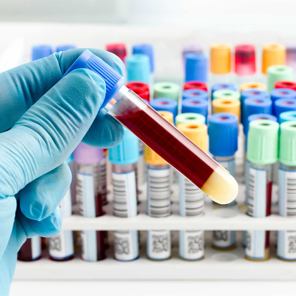 Measurement of the Direct Oral Anticoagulants Apixaban, Dabigatran, Edoxaban, and Rivaroxaban